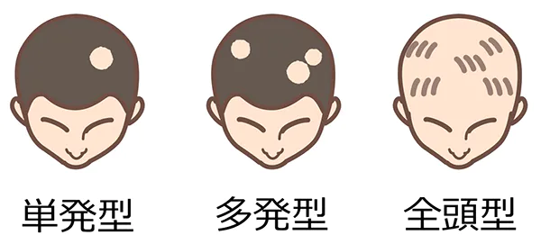 円形脱毛症の症状